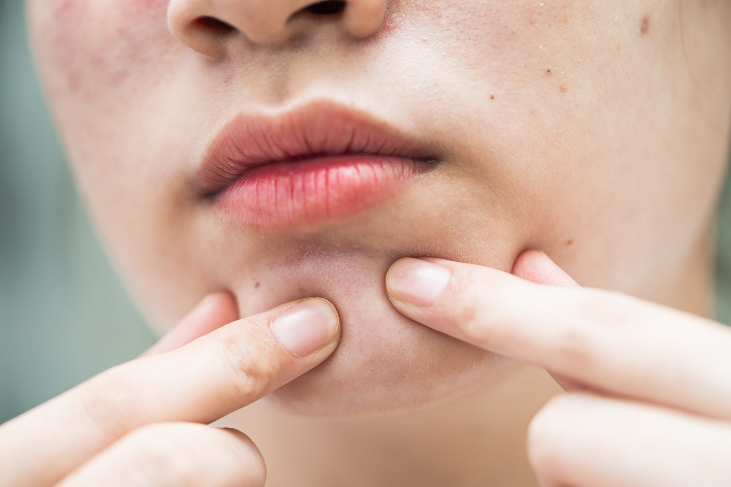 Acne: cuidados essenciais para controlar espinhas