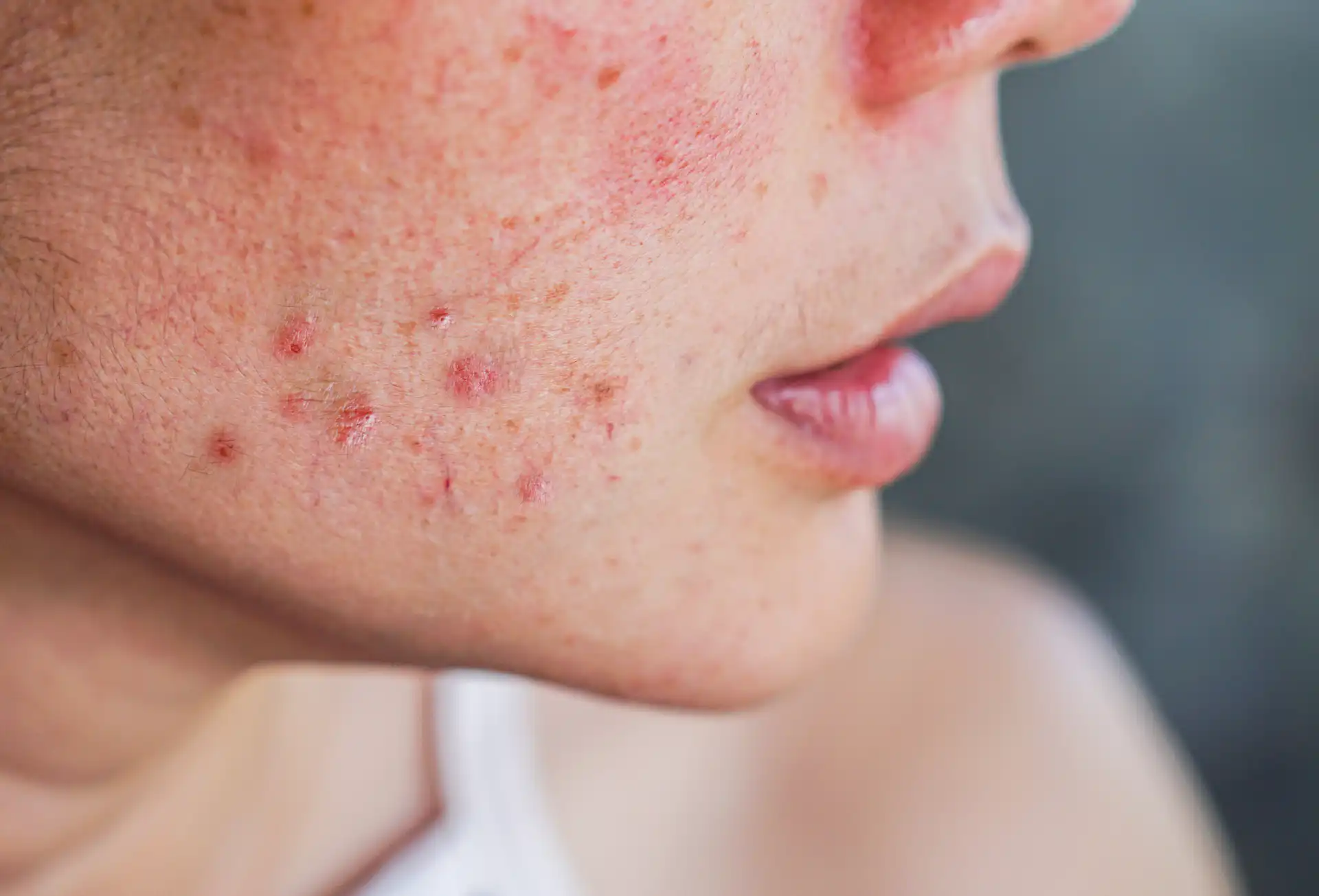 Acne: cuidados essenciais para controlar espinhas