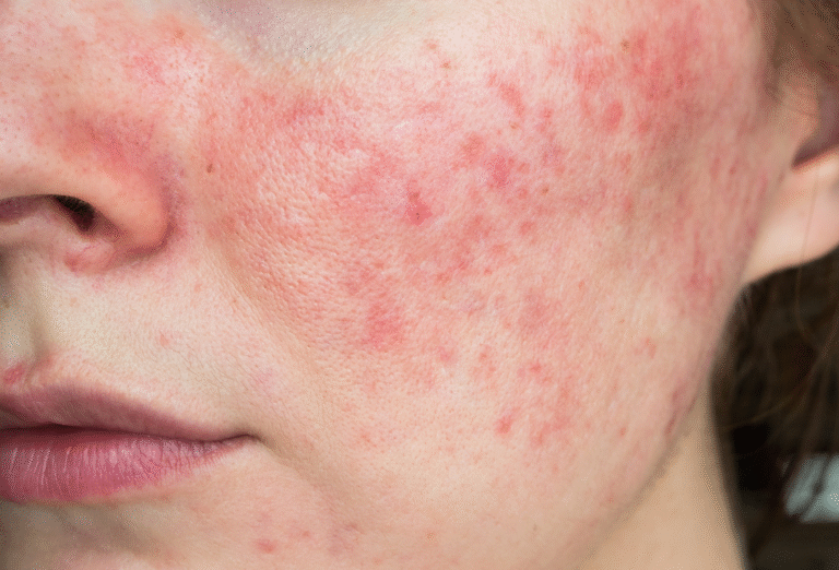 Rosácea: sintomas, causas e tratamentos