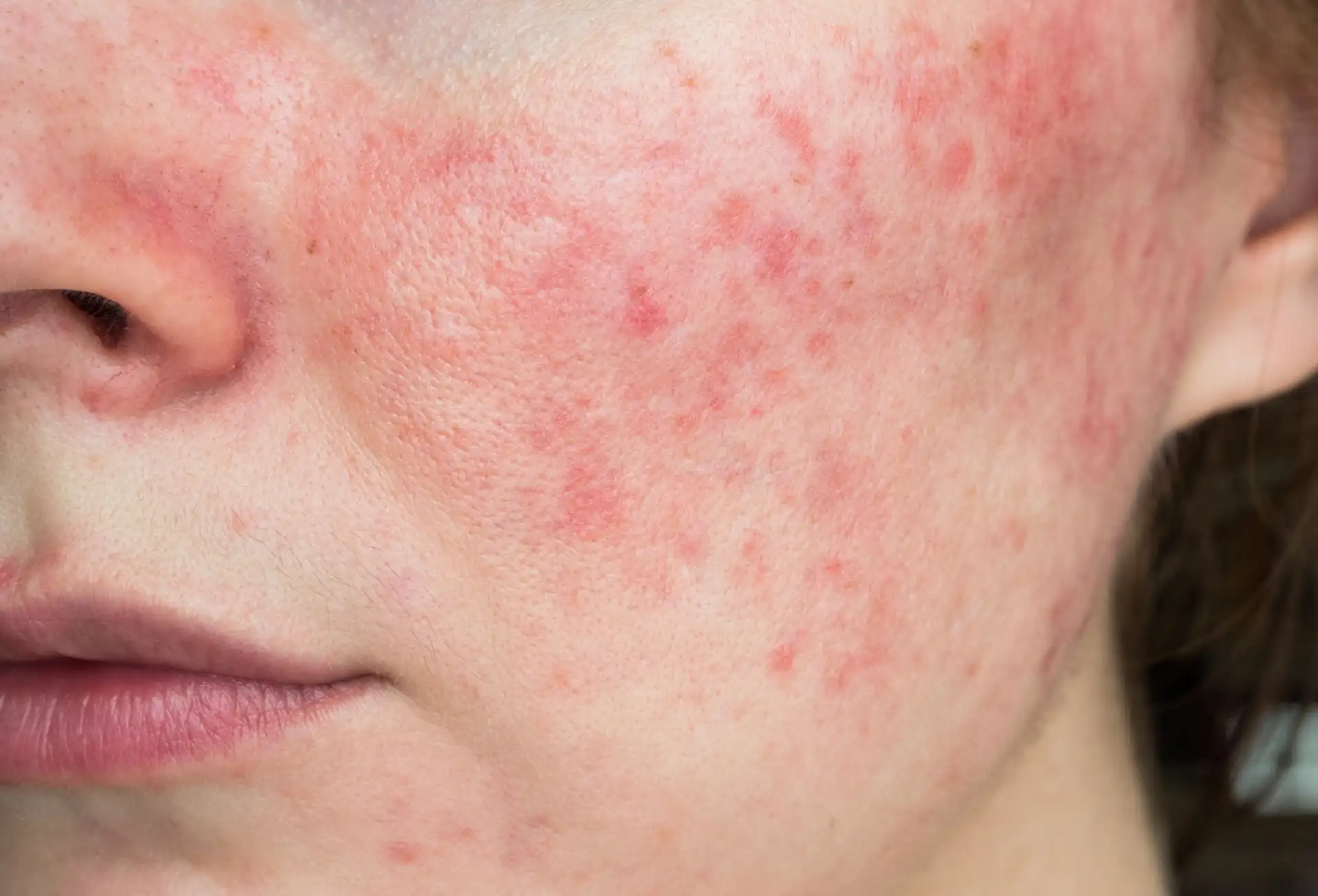 Rosácea: sintomas, causas e tratamentos