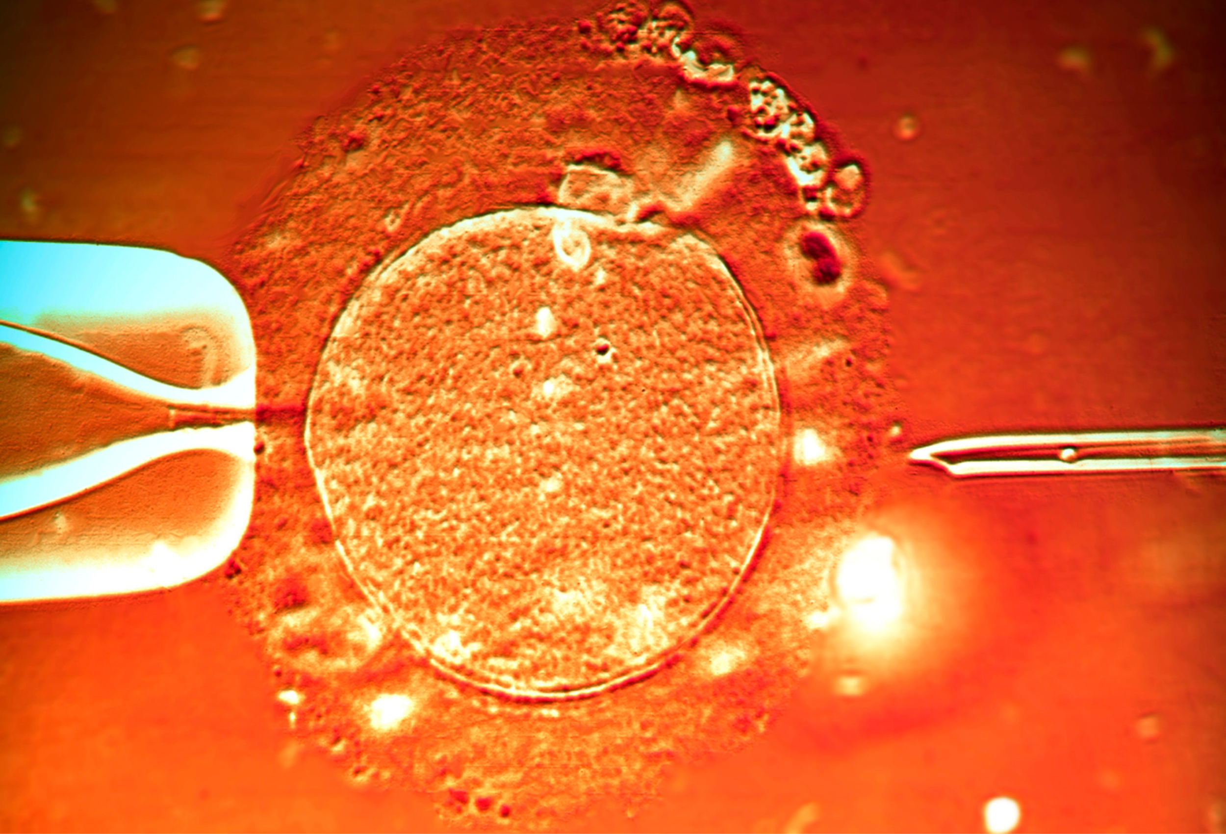 Infertilidade masculina: causas mais comuns e tratamentos